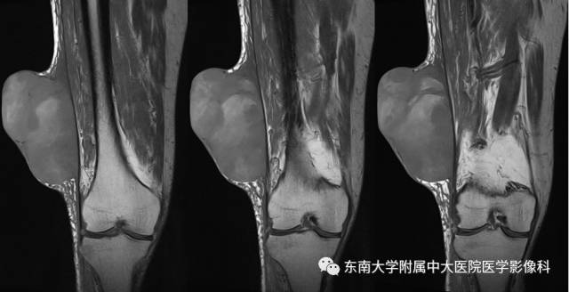 【病例】右侧大腿恶性纤维组织细胞瘤1例
