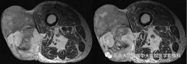【病例】右侧大腿恶性纤维组织细胞瘤1例