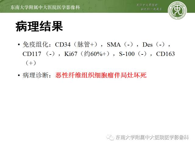 【病例】右侧大腿恶性纤维组织细胞瘤1例