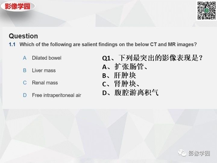 【病例】左肝恶性神经内分泌肿瘤1例CT