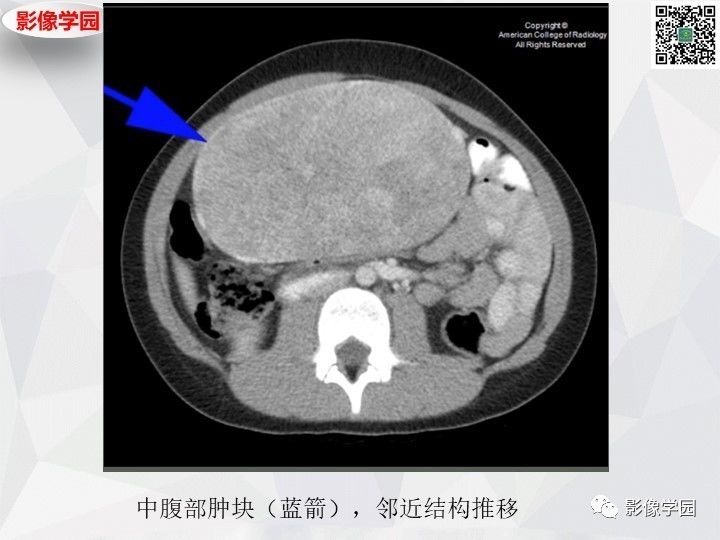 【病例】左肝恶性神经内分泌肿瘤1例CT