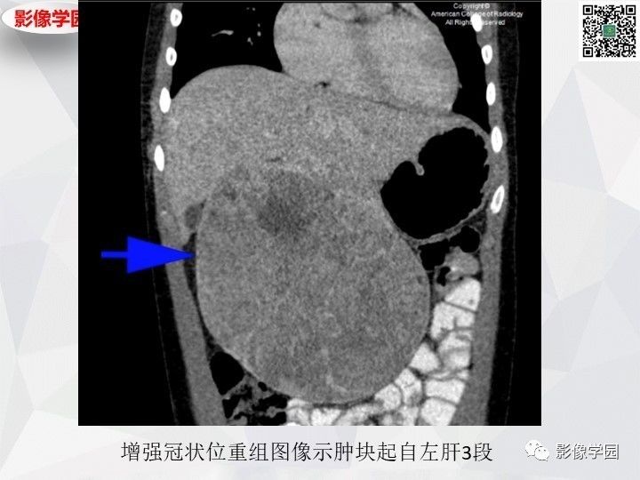 【病例】左肝恶性神经内分泌肿瘤1例CT
