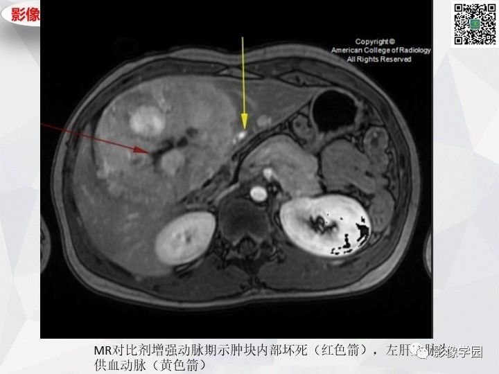 【病例】左肝恶性神经内分泌肿瘤1例CT