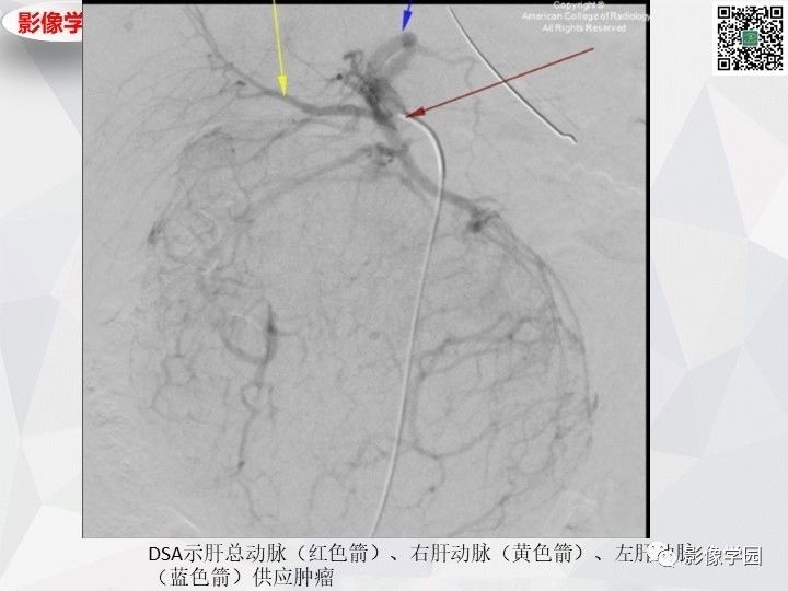 【病例】左肝恶性神经内分泌肿瘤1例CT