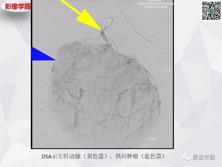 【病例】左肝恶性神经内分泌肿瘤1例CT