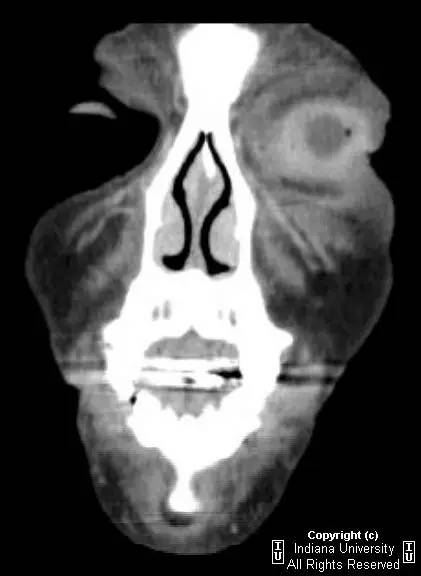 【病例】左眼角膜结膜炎1例CT影像表现 【病例】左眼角膜结膜炎1例CT影像表现