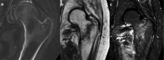 可疑髋部骨折：为什么首选 MRI，而不是 CT