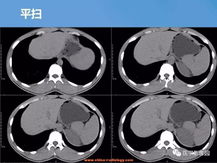 【病例】肾脏原始神经外胚层肿瘤1例CT影像表现