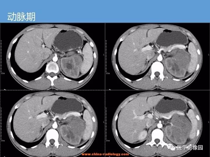 【病例】肾脏原始神经外胚层肿瘤1例CT影像表现