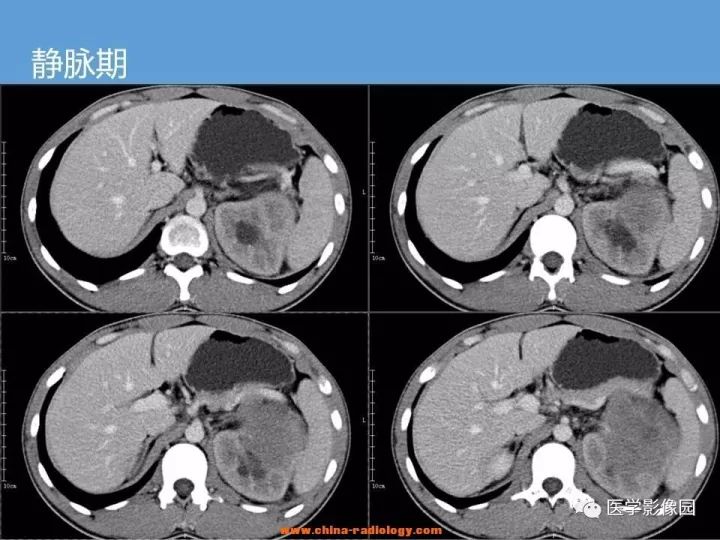 【病例】肾脏原始神经外胚层肿瘤1例CT影像表现