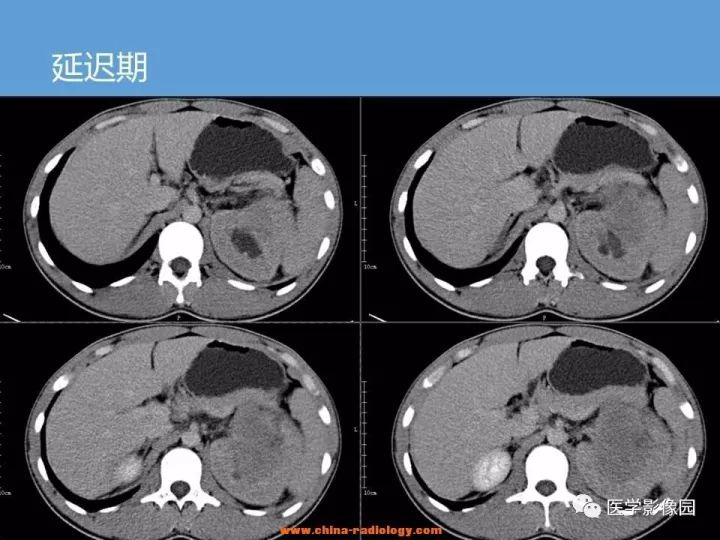 【病例】肾脏原始神经外胚层肿瘤1例CT影像表现
