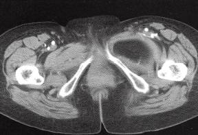 【病例】左大腿畸胎瘤1例CT影像表现 【病例】左大腿畸胎瘤1例CT影像表现