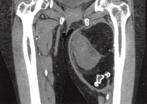 【病例】左大腿畸胎瘤1例CT影像表现 【病例】左大腿畸胎瘤1例CT影像表现