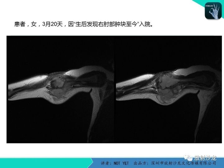 【病例】左上臂纤维肉瘤1例MR