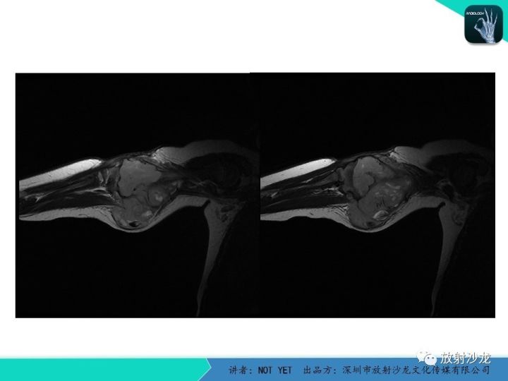 【病例】左上臂纤维肉瘤1例MR