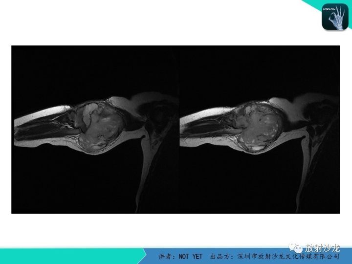 【病例】左上臂纤维肉瘤1例MR