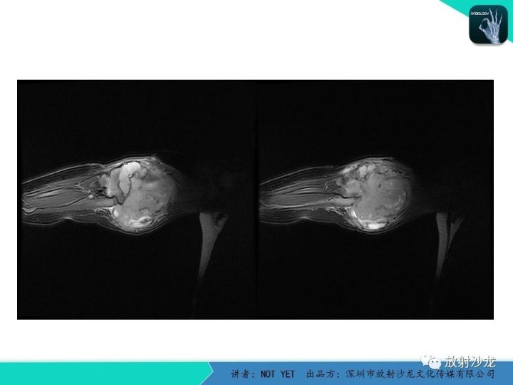 【病例】左上臂纤维肉瘤1例MR