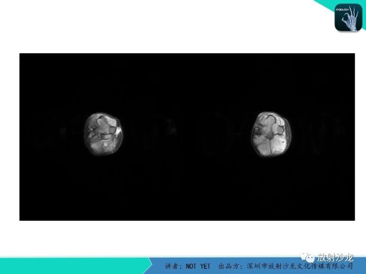 【病例】左上臂纤维肉瘤1例MR
