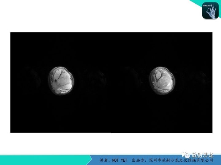 【病例】左上臂纤维肉瘤1例MR