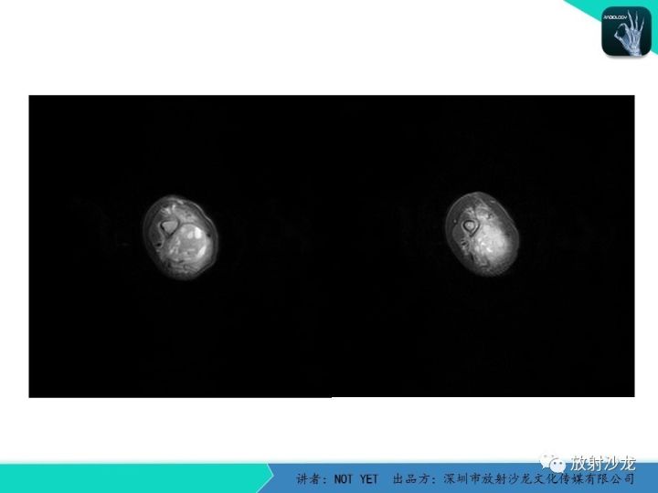 【病例】左上臂纤维肉瘤1例MR
