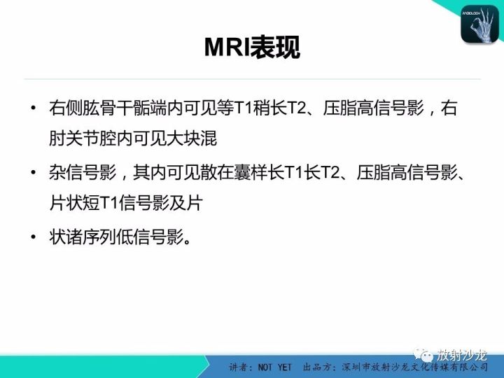 【病例】左上臂纤维肉瘤1例MR