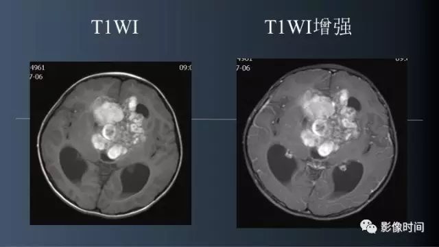 【误诊病例】鞍区巨大血管畸形1例CT及MR