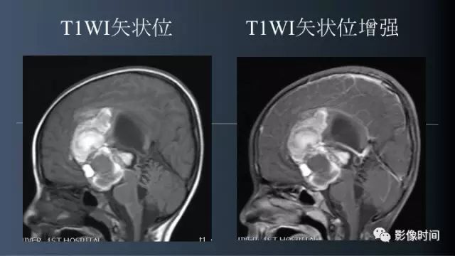 【误诊病例】鞍区巨大血管畸形1例CT及MR