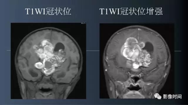 【误诊病例】鞍区巨大血管畸形1例CT及MR