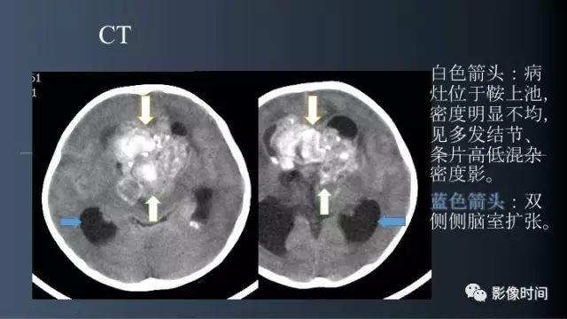 【误诊病例】鞍区巨大血管畸形1例CT及MR