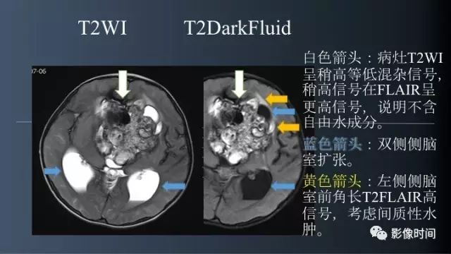 【误诊病例】鞍区巨大血管畸形1例CT及MR