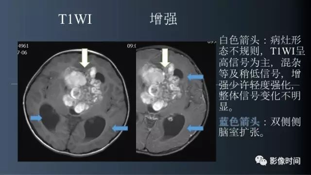 【误诊病例】鞍区巨大血管畸形1例CT及MR