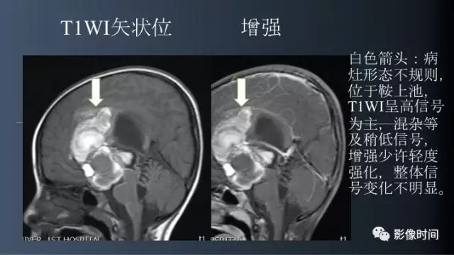 【误诊病例】鞍区巨大血管畸形1例CT及MR