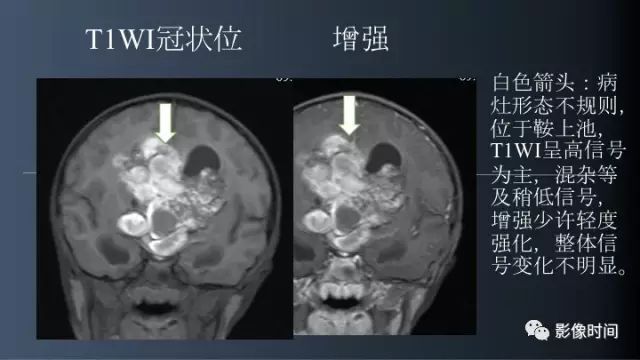【误诊病例】鞍区巨大血管畸形1例CT及MR