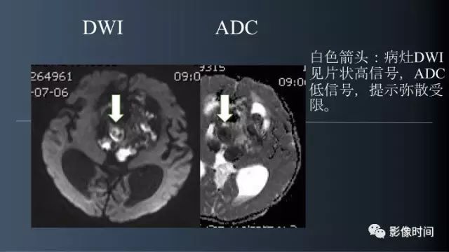 【误诊病例】鞍区巨大血管畸形1例CT及MR