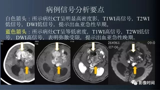 【误诊病例】鞍区巨大血管畸形1例CT及MR
