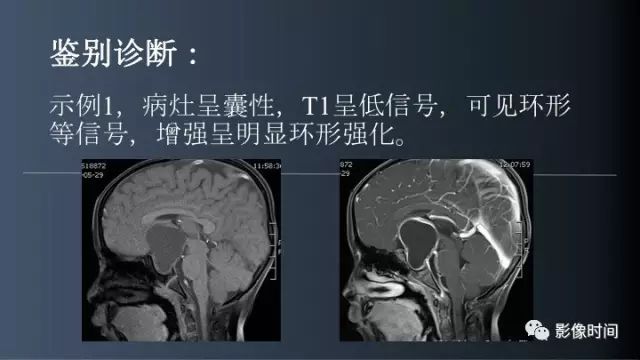 【误诊病例】鞍区巨大血管畸形1例CT及MR