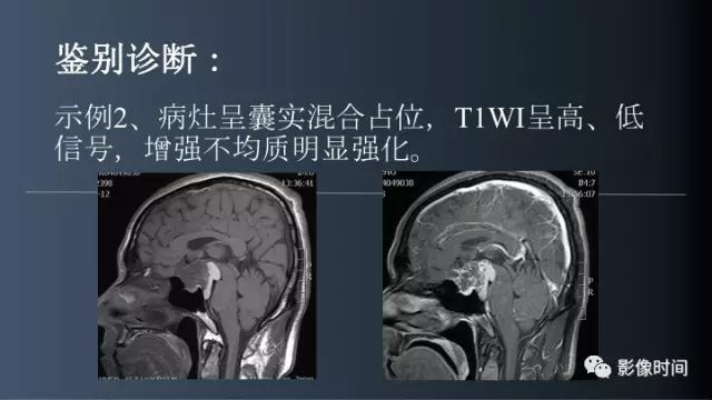 【误诊病例】鞍区巨大血管畸形1例CT及MR