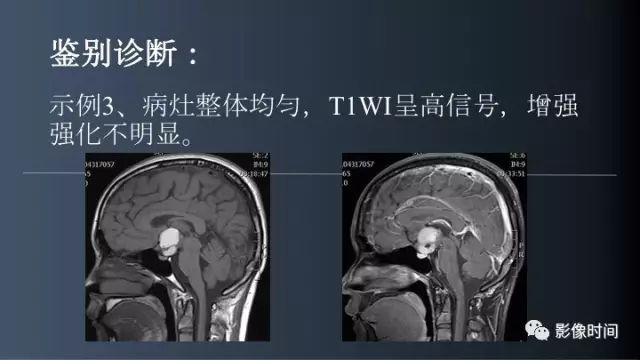 【误诊病例】鞍区巨大血管畸形1例CT及MR