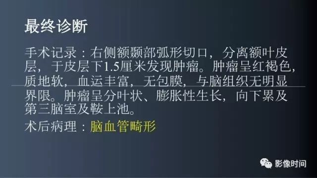 【误诊病例】鞍区巨大血管畸形1例CT及MR