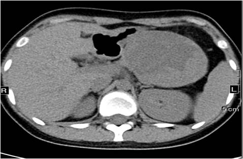 【病例】胰腺实性假乳头状瘤1例CT影像表现