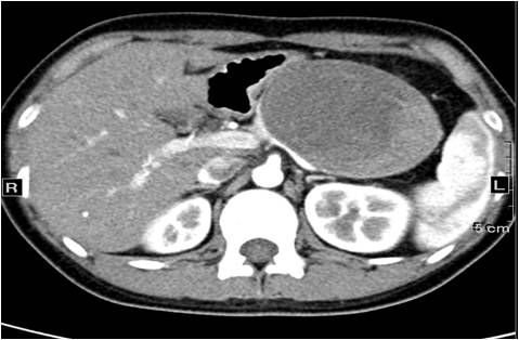 【病例】胰腺实性假乳头状瘤1例CT影像表现