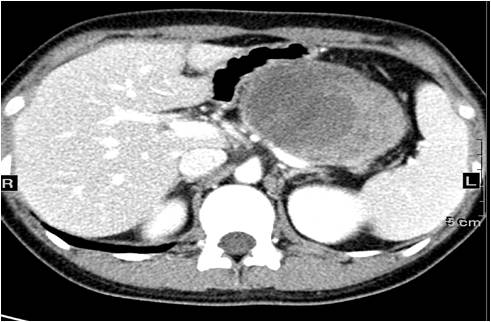 【病例】胰腺实性假乳头状瘤1例CT影像表现