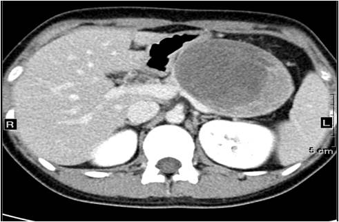 【病例】胰腺实性假乳头状瘤1例CT影像表现