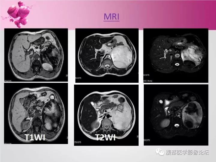 【病例】肾上腺髓质脂肪瘤1例CT及MR诊断与鉴别诊断