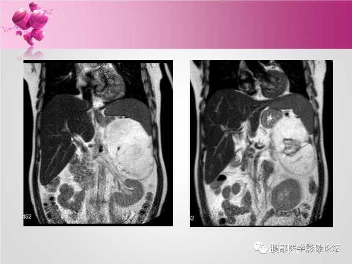 【病例】肾上腺髓质脂肪瘤1例CT及MR诊断与鉴别诊断