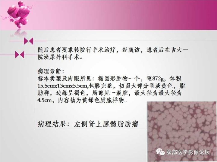 【病例】肾上腺髓质脂肪瘤1例CT及MR诊断与鉴别诊断