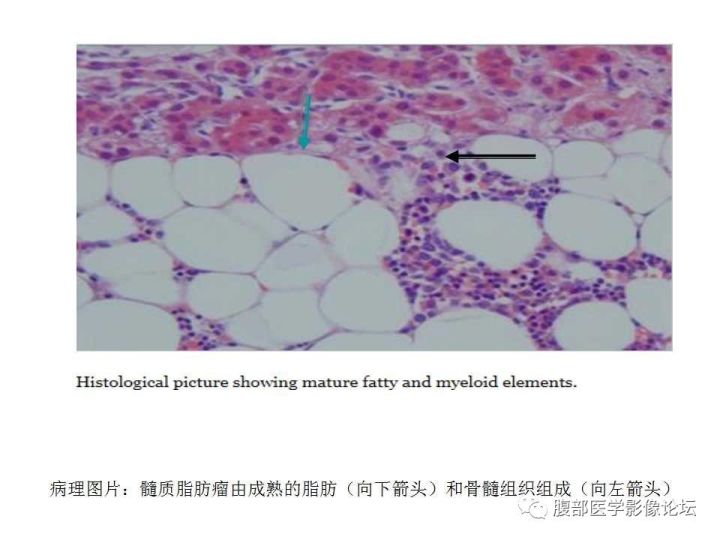 【病例】肾上腺髓质脂肪瘤1例CT及MR诊断与鉴别诊断
