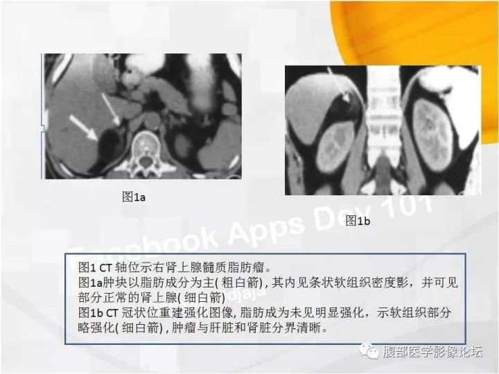 【病例】肾上腺髓质脂肪瘤1例CT及MR诊断与鉴别诊断