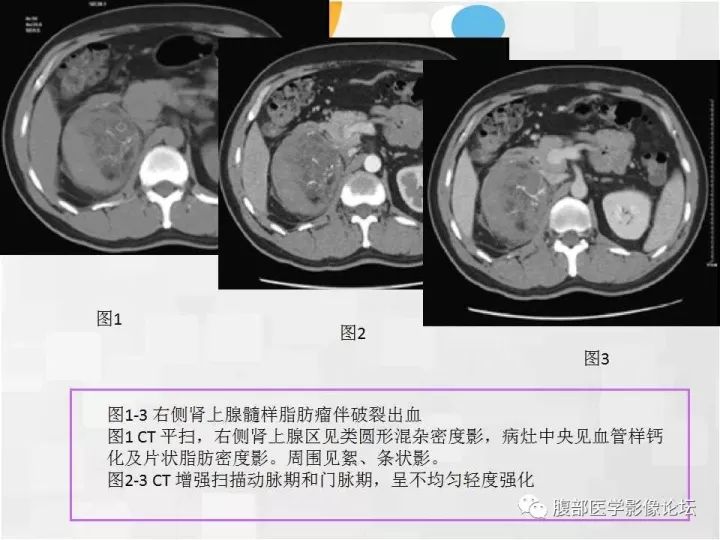 【病例】肾上腺髓质脂肪瘤1例CT及MR诊断与鉴别诊断