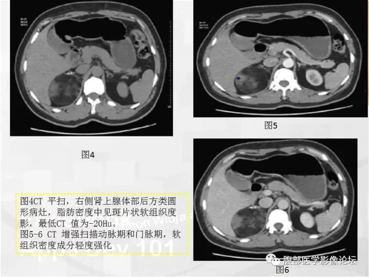 【病例】肾上腺髓质脂肪瘤1例CT及MR诊断与鉴别诊断
